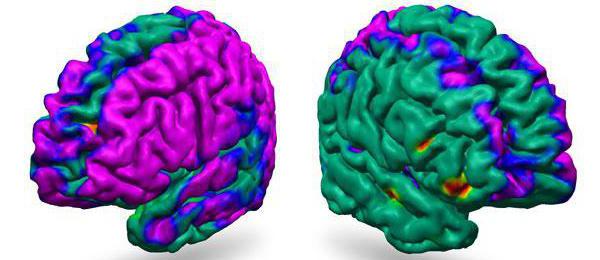 lekkie rozproszone zmiany bioelectric aktywności mózgu