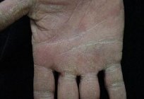 Wie zu heilen Ekzeme auf den Händen und was es ist?