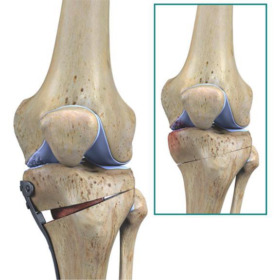 las osteotomías pies