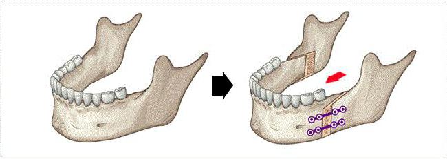 las osteotomías de la mandíbula