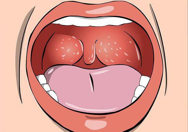 a canker sore on gland