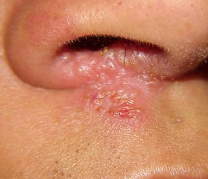 fungus in the nose