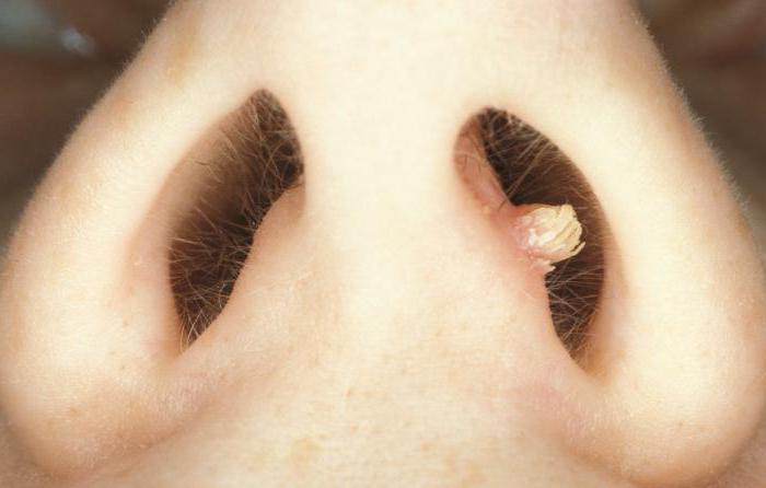 fungus in nose symptoms