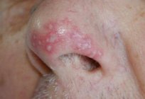 Pilz in der Nase: Symptome, Behandlung, Foto