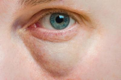 Swelling under eye causes on the one hand