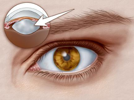 "العيون" جهاز لعلاج إعتام عدسة العين السعر