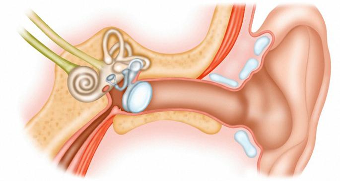 المكونات في الأذن الأعراض