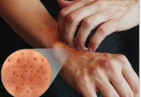 Quais são as causas da acne em mãos?