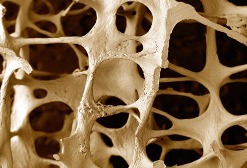 la osteoporosis, las articulaciones