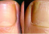 を識別する方法について爪真菌に足の症状は、その原因と治療