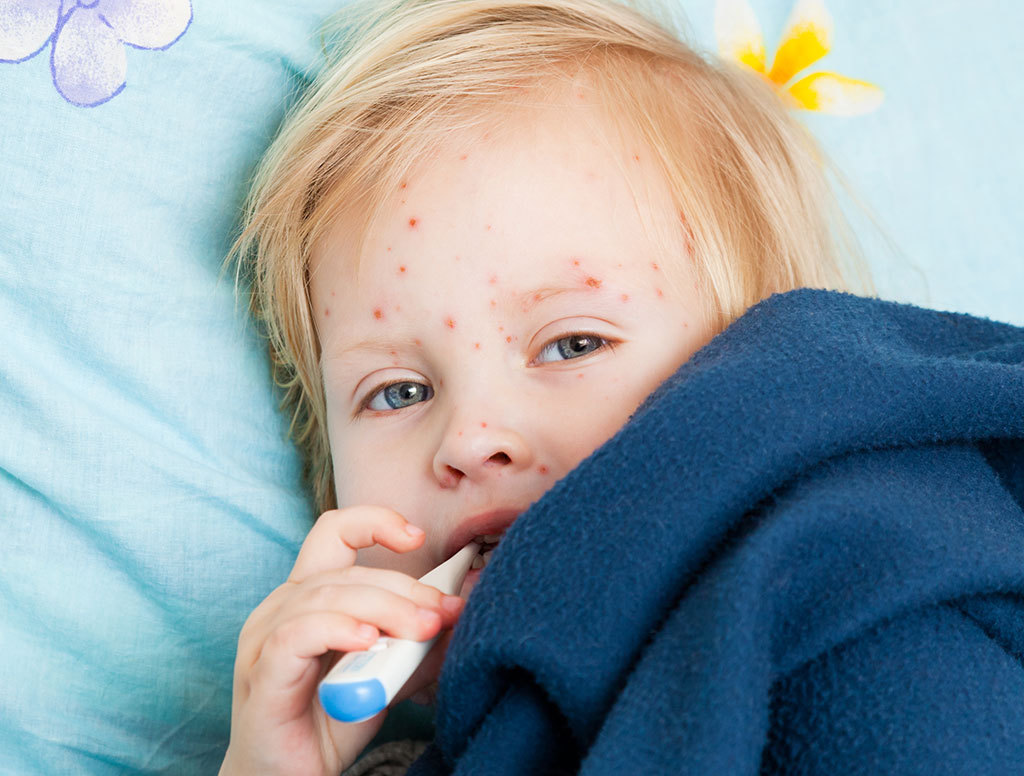 how to treat chickenpox in children in addition to green fodder