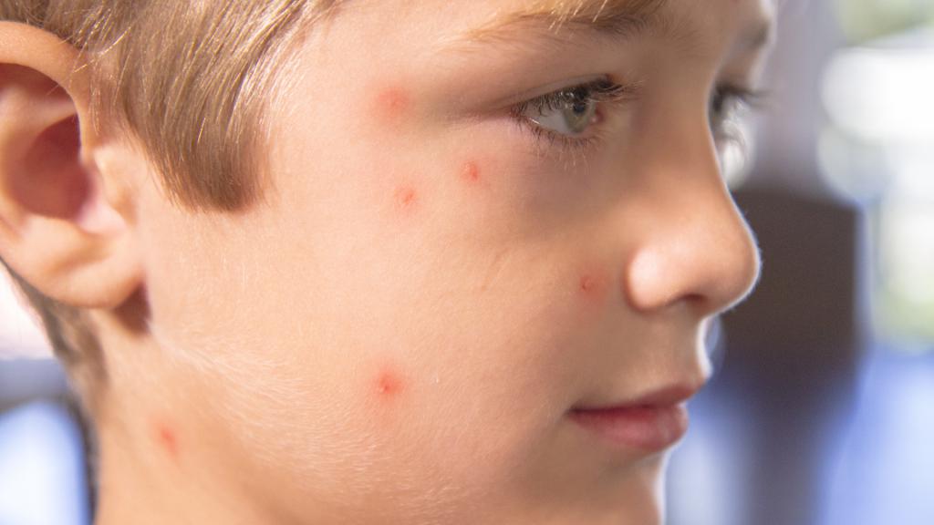 how to treat chicken pox at home adult