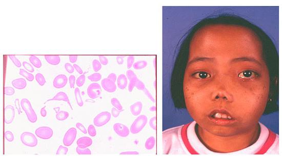 thalassemia symptoms