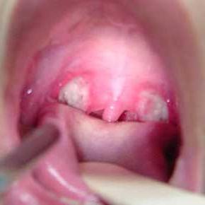 Treatment of streptococcal infection in the throat