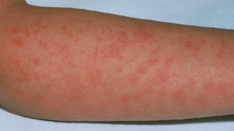 連鎖球菌由来感染症の皮膚の治療