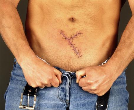 how to handle sutures after the surgery