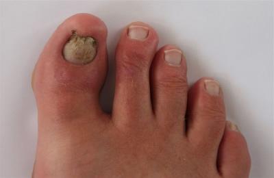 treatment of fungal infections