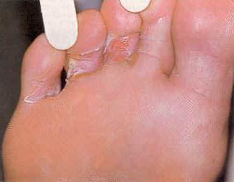 真菌症の足