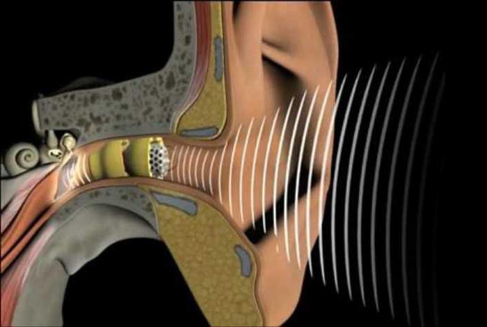 відновлення слуху при нейросенсорної приглухуватості