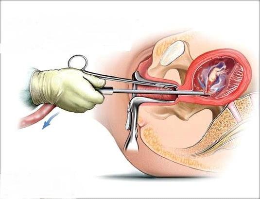 хірургічны аборт водгукі