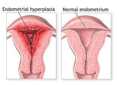 skrobanie podczas rozrostu endometrium