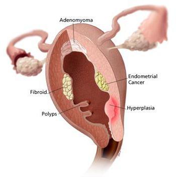 hiperplasia do endométrio após a raspagem