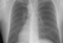 Dupla туберкулиновой amostras de crianças: causas, sintomas, diagnóstico e características de tratamento