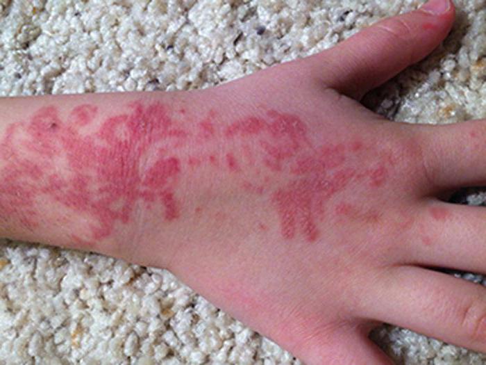 la alergia a la tinta del tatuaje