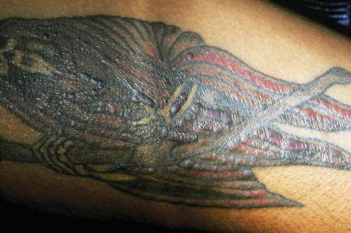 アレルギーのある赤色のタトゥー