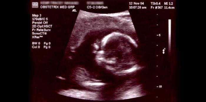tarama 1 trimester normal ultrason