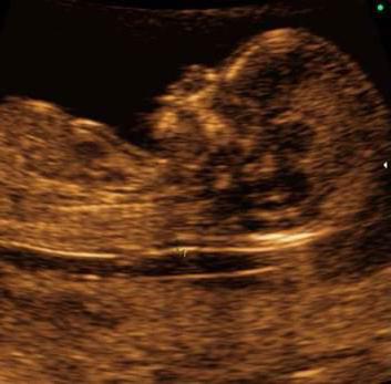 norm tarama 1 trimester deşifre ultrason