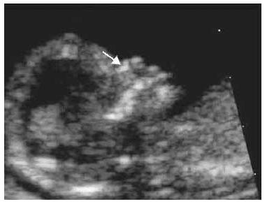 tarama 1 trimester normal ultrason burun kemiği