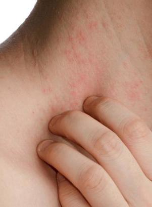 causes of hives in adults