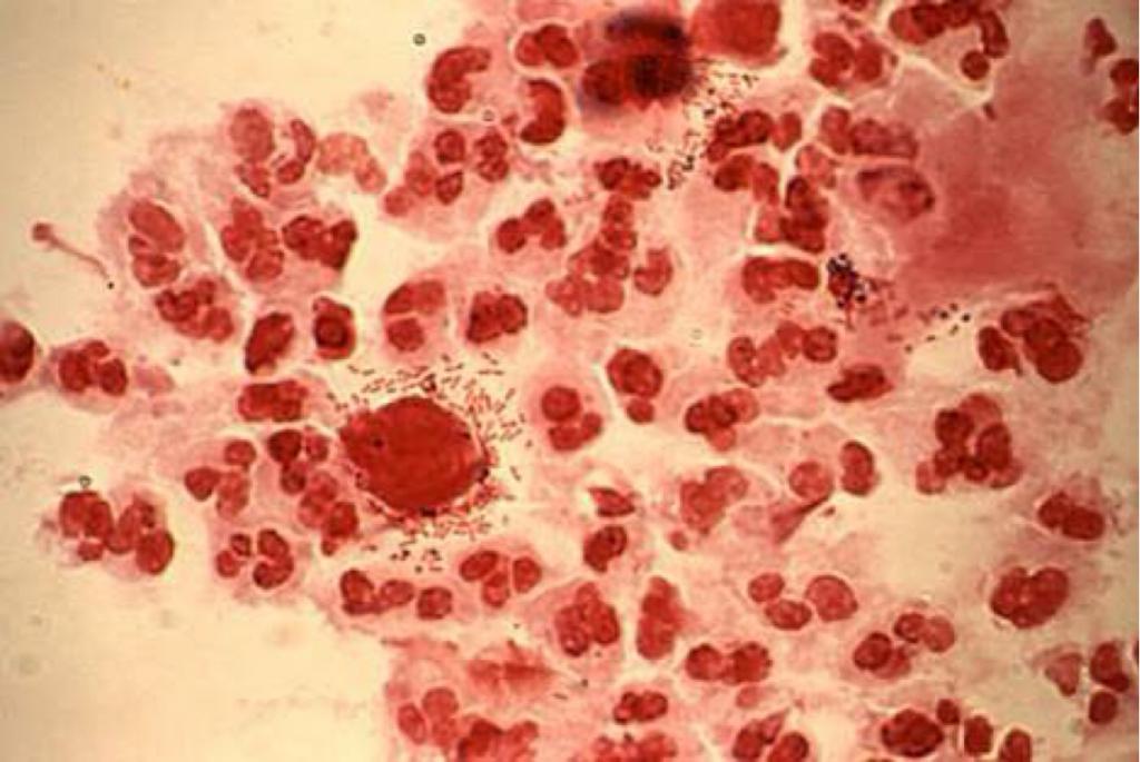 mukus vajinal trichomoniasis