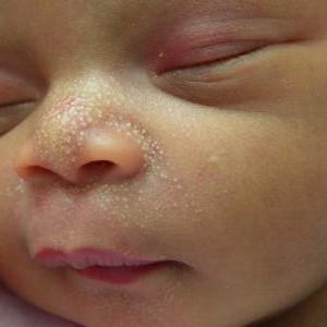 puntos blancos en la nariz del recién nacido