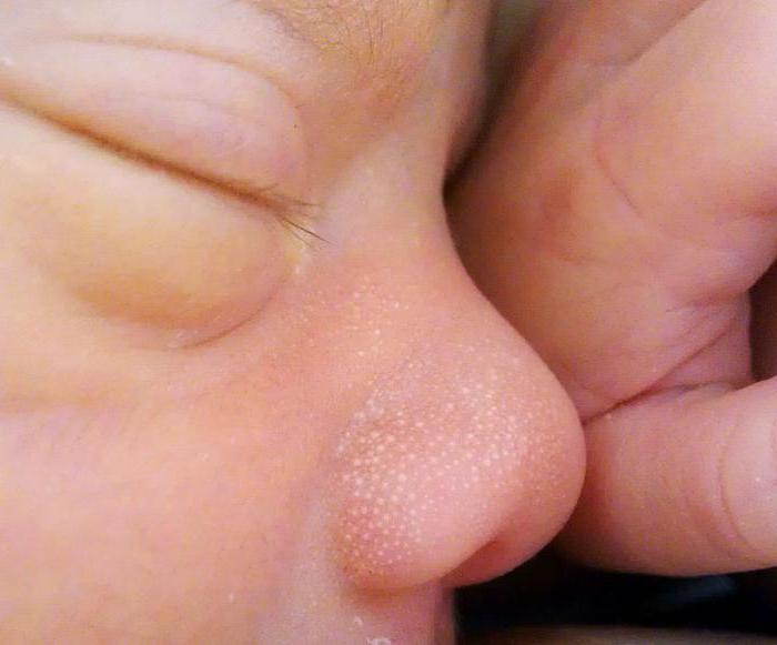 weiße Punkte auf der Nase des Babys