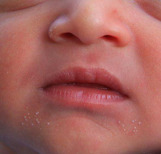 weiße Punkte auf der Nase des Neugeborenen stattfinden, wenn