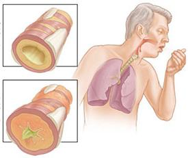 慢性閉塞性肺疾患COPD（慢性閉塞性肺疾患）
