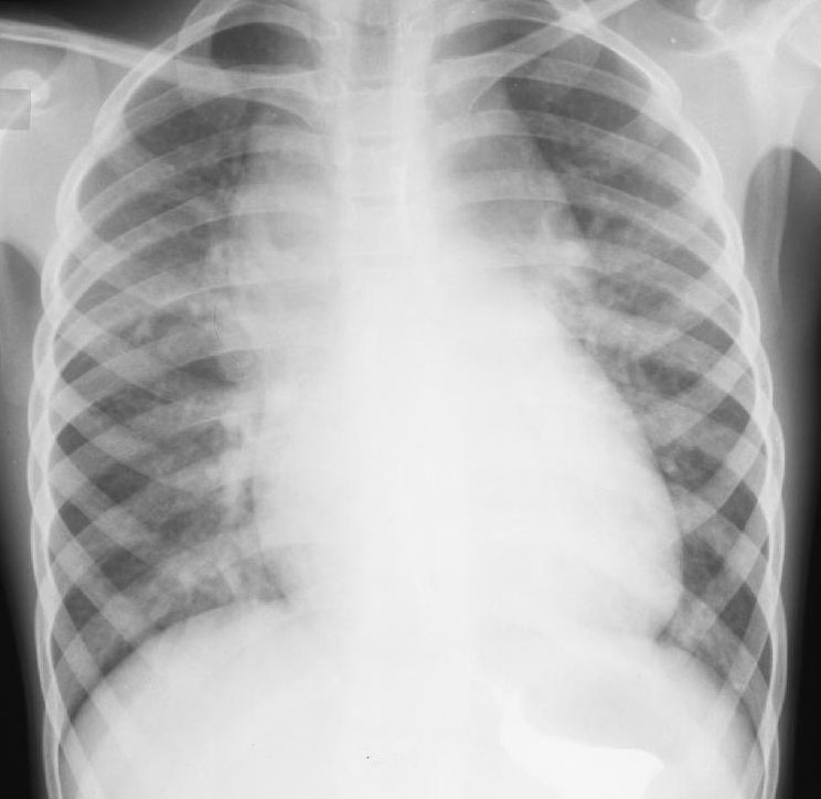 Röntgenstrahlen bei Lungenerkrankung Herz
