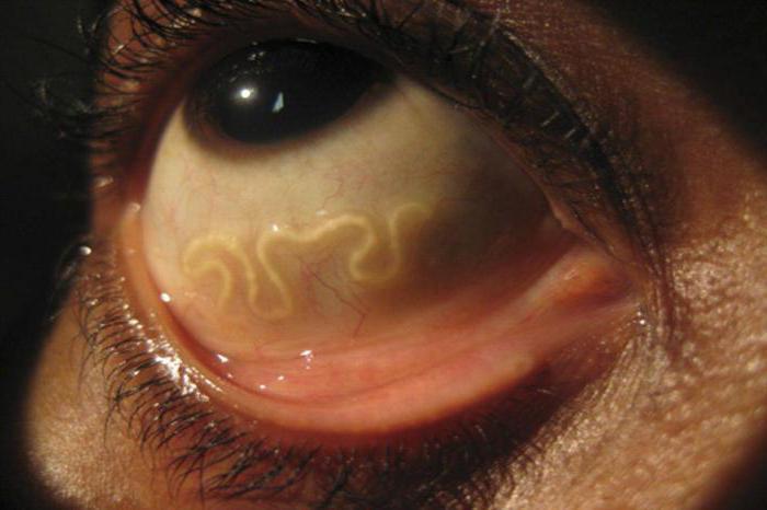 parásitos en los ojos