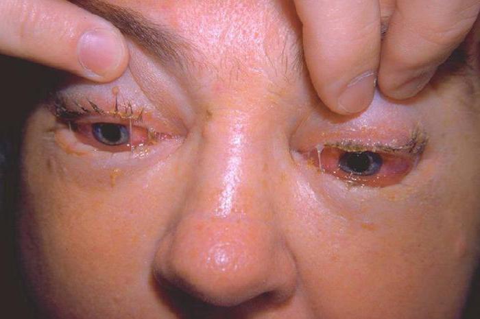 parásitos a los ojos de los humanos, los síntomas de la