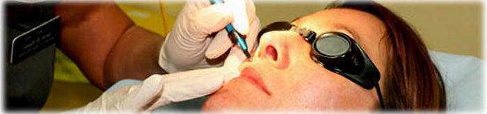 remove blood vessels on the face with laser reviews