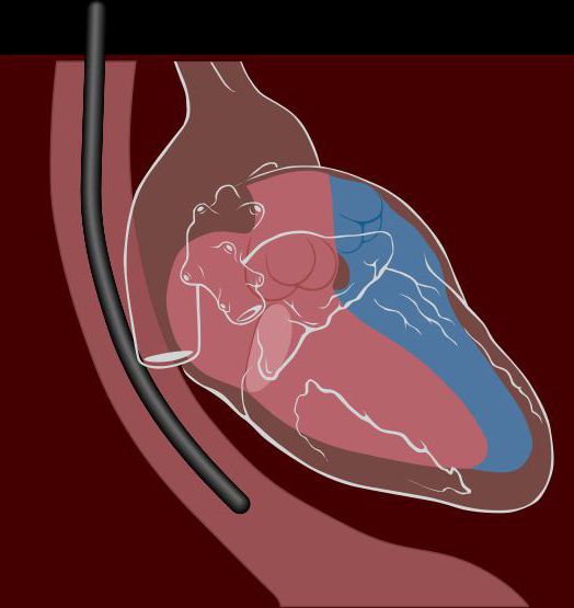transesophageal echocardiography