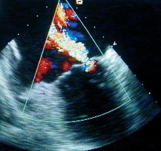 transesophageal इकोकार्डियोग्राफी दिल के प्रदर्शन
