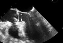 Чреспищеводная ecocardiograma: ¿qué es?