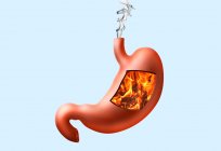 什么帮助胃灼热：药物清单