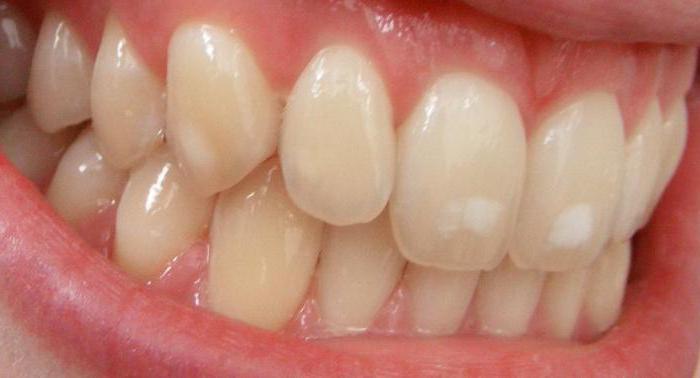 forms of fluorosis
