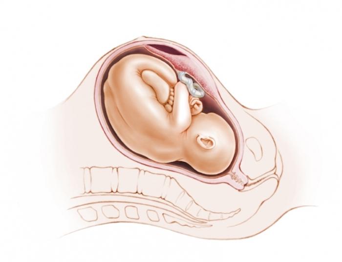 os Sintomas do descolamento de placenta