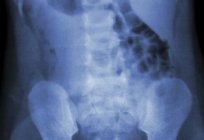X線の腰椎:目的の特徴および復号化