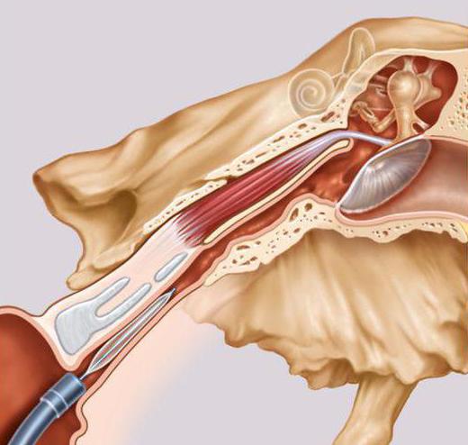 inflammation of the auditory Eustachian tube treatment